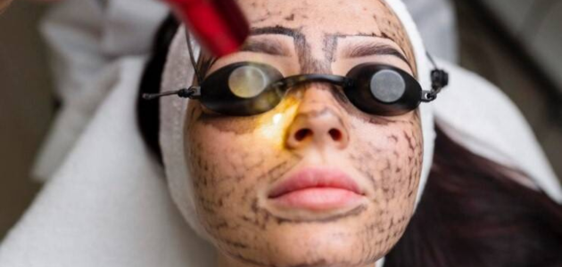 What is laser facial peeling technology?