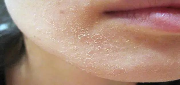 نصائح عند تطبيق عملية إزالة قشور الوجه 