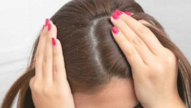 أسباب قشرة الشعر وعلاجها