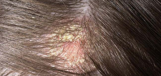 علاج جفاف فروة الرأس والتخلص من قشرة الشعر المرتبطة به